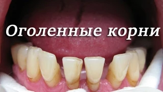 Как лечится рецессия десны. Что делать если оголились корни в зубах  Стоматология