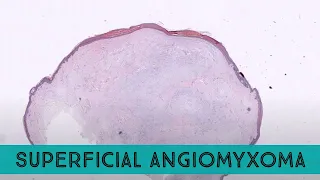 Superficial angiomyxoma (cutaneous myxoma) pathology dermpath dermatology dermatopathology