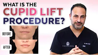 What is the CUPID LIFT™ Procedure?
