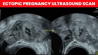 Ectopic Pregnancy Ultrasound Scan | Dr Kunal Rathod