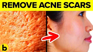 9 Ways To Treat Acne Scarring