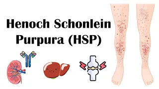 Henoch Schoenlein Purpura (HSP) - Causes, Pathophysiology, Diagnosis, And Treatment