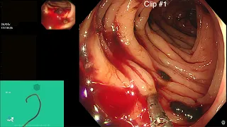 SEVERE COLONIC DIVERTICULAR BLEED