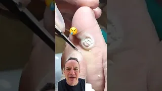 DOCTOR REACTS: AMAZING PLANTAR WART CURE! 😱 #shorts