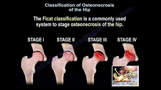 Osteonecrosis Of The Hip Ficat Classification - Everything You Need To Know - Dr. Nabil Ebraheim