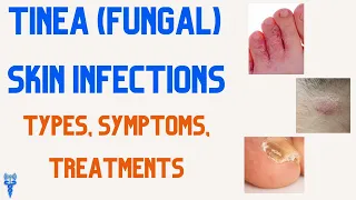 TINEA (FUNGAL) SKIN INFECTIONS