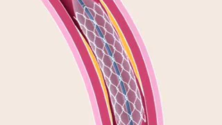 Stent Implant | ESMR Treatment in Pune, India | Best Cardiologist in India | Dr. Rahul Patil