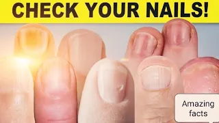 9 things your nails can tell you about your health #nails #instagram #viral