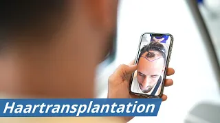 Meine Haartransplantation Erfahrungen in der Türkei | Elithair