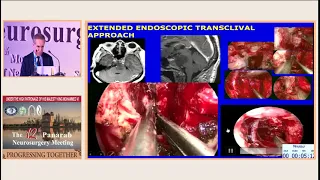 SMNC/PANS 2018- Prof Fred Gentili: Evolution of Skull base surgery for open to endoscopic techniques