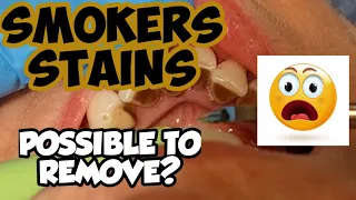 SMOKERS STAIN Stain removal - Professional Cleaning