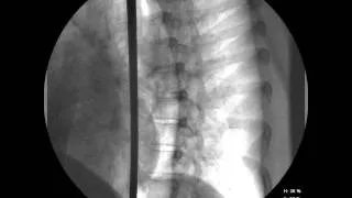 Röntgenaufnahmen vom Schwertschlucken - Sword Swallow X-Ray