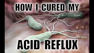 How I cured my Acid Reflux and Helicobacter Pylori infection (without antibiotics)