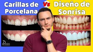 Carillas Dentales Vs Diseño de Sonrisa | Lo que tienes que saber antes de decidir