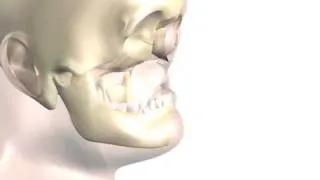 Near-Total Face Transplant Surgical Animation