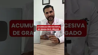 ¿TIENES HIGADO GRASO?