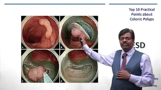 Top10 Practical Points Colonic Polyps