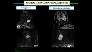 MRI of breast lesions  Dr  Rasha Kamal in English 720p