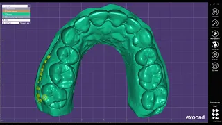 wax up цифровое моделирование для диагностики согласования плана лечения пациента. Моделировка зубов