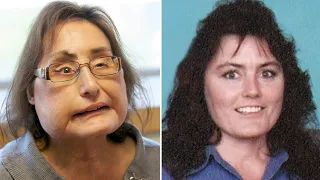 Ohio woman who received first US face transplant dead at 57