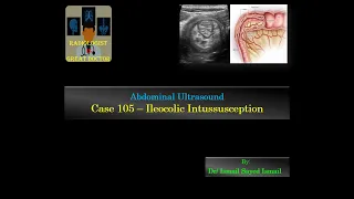 Ultrasound Case 105 - Ileocolic Intussusception