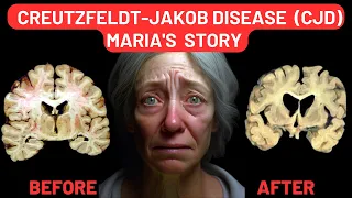 Unravelling the Mystery of Creutzfeldt-Jakob Disease Maria's Story