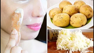 i Rub Potato Peel Every Night & Removed Dark Spots in Just 5 Days, Remove Spots & Acne Scars Forever