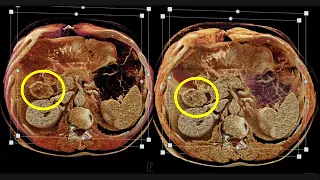CT of Small Bowel GIST Tumors: Imaging and Theory Part 1