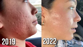 Microneedling Session #8 Before + After