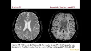 68. CAA, Cerebral Amyloid (micro) Angiopathy; vascular dementia, micro bleeds, superficial siderosis