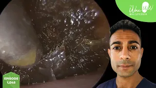 1,048 - Gigantic Ear Wax Removal