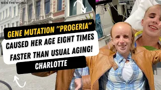 Progeria Genetic Mutation: Ages Deaf Person 8 Times Faster!