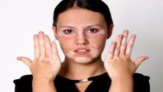 Skin Pigment Loss - Vitiligo