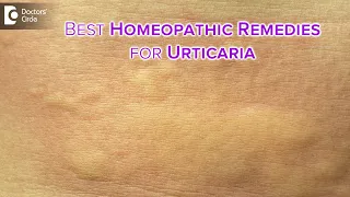 Detailed causes of  URTICARIA or HIVES |  Homeopathic Remedies -Dr.V.Bhagyalakshmi | Doctors' Circle