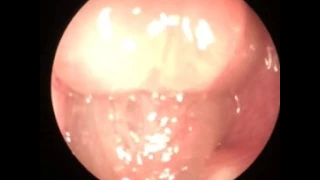 Stage 3 nasal polyposis