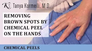 Removing brown spots by Chemical Peel on the Hands