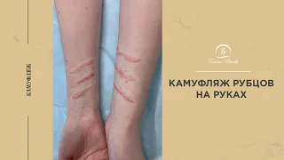 Камуфляж рубцов на руке