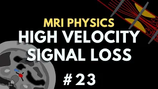 High Velocity Signal Loss (HVSL), Time of Flight Effect and Turbulence | MRI Physics Course #23