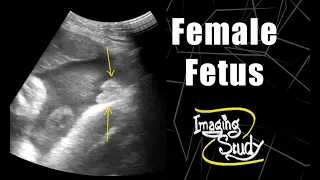 Female Fetus - Its a Girl || Ultrasound || Case 64