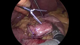 Laparoscopic Mini Gastric Bypass  Dr vikrant