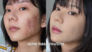 acne skin ʚɞ ༘⋆ acne coverage base routine | cover acne easily with makeup