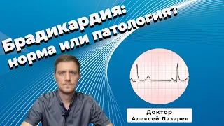 БРАДИКАРДИЯ: норма или патология? #брадикардия #экг #докторАлексейЛазарев