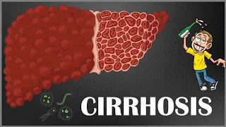 Signs And Symptoms Of Liver Cirrhosis