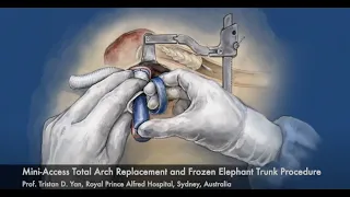 Mini-access branch-first total arch replacement and frozen elephant trunk procedure—how I do it