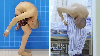 Man Lived Folded In Half For 28 Years