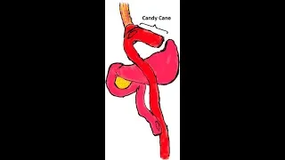Laparoscopic candy cane resection for "Candy Cane Syndrome" - Amir Aryaie , MD; Bariatric surgeon