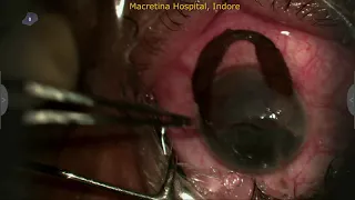 Corneal Tear Repair