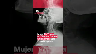 Mujer se traga un clavo al comer chicharrón; Esto pasó después - N+ #Shorts