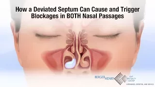 How a Deviated Septum Can Cause Blockages in BOTH Nasal Passages | BergerHenry ENT Doctors