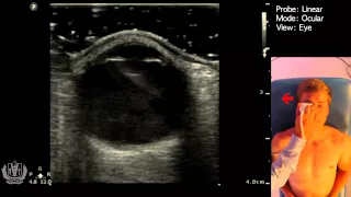 Ocular Ultrasound Basics - Made Simple